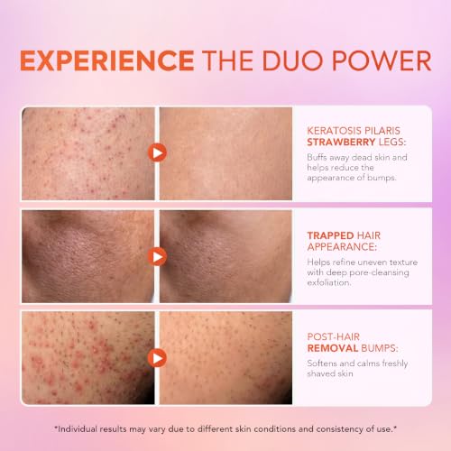 KP Bump Eraser Body Scrub & Lotion Set | Keratosis Pilaris Treatment