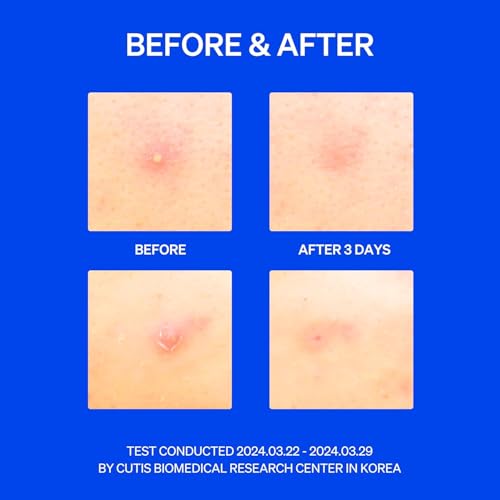 KNEMO Microtip Hydrocolloid Acne Pimple Patches - 8 Pack for Early Zits & Blemishes