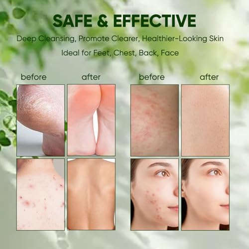 Tea Tree Oil Soap Bar - 3PCS Natural Cleansing Soap with Coconut Oil