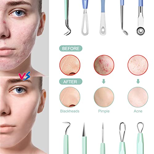 MENOLY 10-Piece Blackhead Remover Tool Kit with Anti-Slip Handle