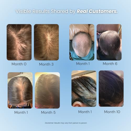 Growplex 5% Minoxidil Foam for Hair Regrowth Men & Women