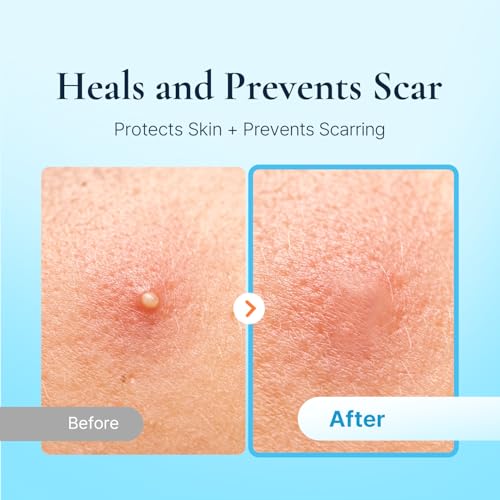 Discreet Acne Pimple Patch | Spot Cover Treatment Solution Cystic Acne Pimple Scars | Hydrocolloid Facial Stickers | Waterproof Patches Quick Healing Pimples