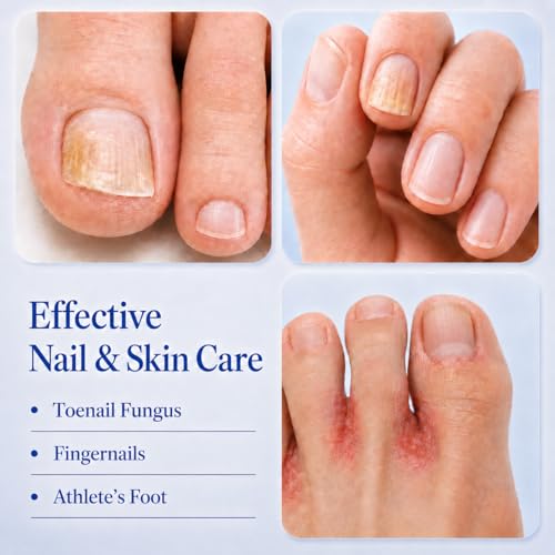 Toenail Fungus Treatment Pen with 25% Undecylenic Acid - 4 Pack
