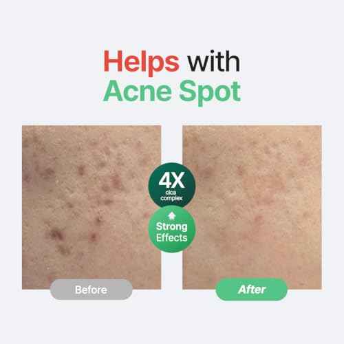 PURITO Centella Unscented Serum, 34,860 ppm Centella, Facial Serum for Sensitive Skin & Acne-Prone Skin, Soothing Serum, Vegan & Cruelty-Free, Korean Skincare, 2 fl.oz / 60ml