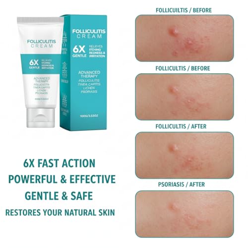 Folliculitis Cream – Cooling Menthol Relief for Itchy Bumpy Skin