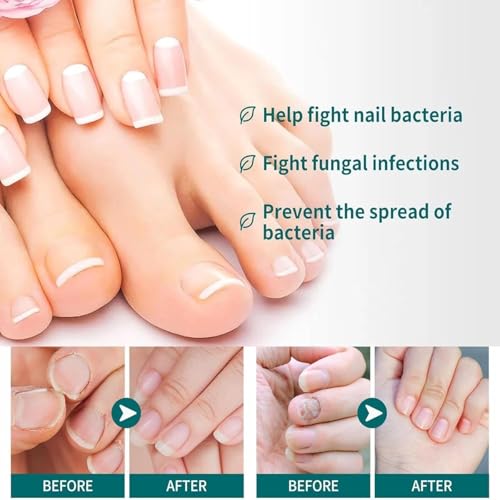 Nail Fungus Treatment Pen - Extra Strength Toenail Repair, 4 Pack