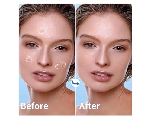 Acne Patches 300 Count Hydrocolloid Pimple Patches 4 Sizes