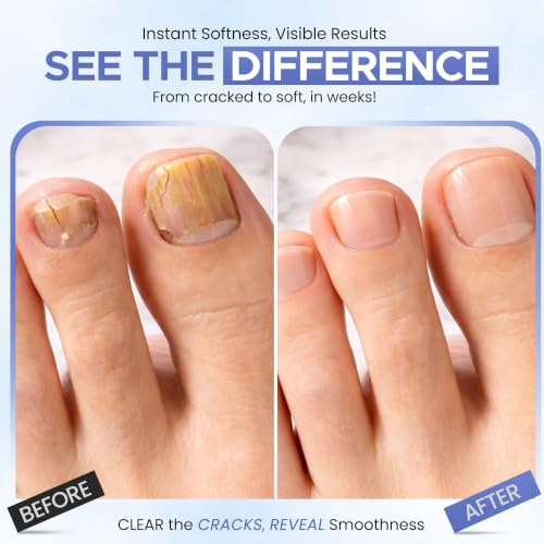 Blue Urea 50% Nail Gel for Cracked Heels & Thick Toenails - Soften & Restore