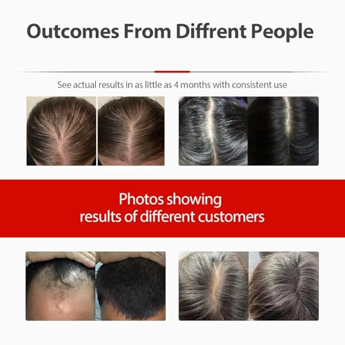 Red Light Therapy Hair Growth Cap with Laser Hat