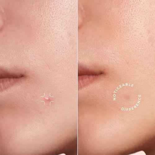 Clear Pimple Patches ? 72 Ct Hydrocolloid Acne Patches w/ Salicylic Acid & Tea Tree Oil ? Fast-Acting Zit Stickers for Face, Blemish & Spot Treatment ? Invisible, Waterproof & Gentle for All Skin