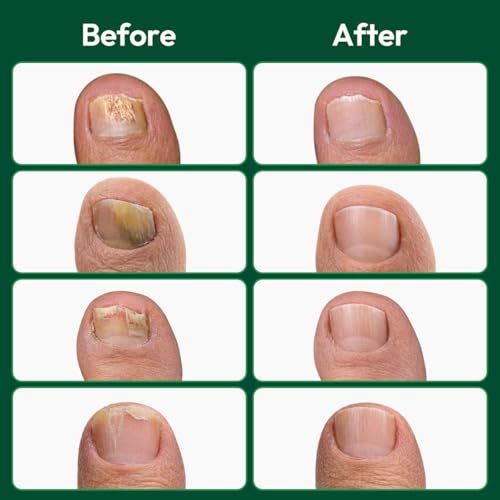 VERDORA FIXLAB Extra Strength Nail Patches with Tea Tree Oil - 16 Pack