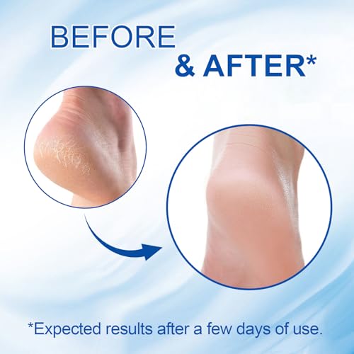 60% Urea Foot Cream Stick with 2% Salicylic Acid for Dry Cracked Heels