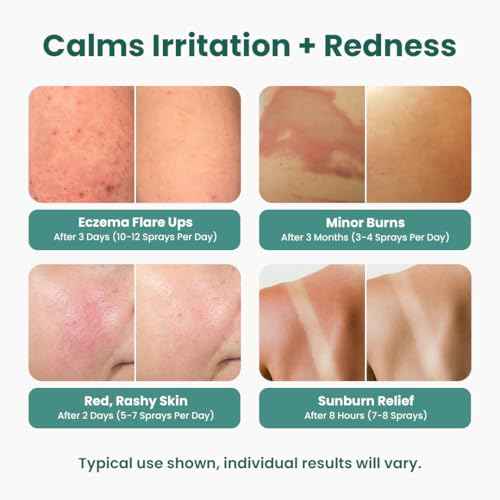 Hypochlorous Acid Spray for face (8 oz) - Face Spray for Acne, Hypochlorous Travel Size Gentle Facial & Skin Cleansing for Body, Back, Skin and Facial Cleaning & Repair - Made in USA