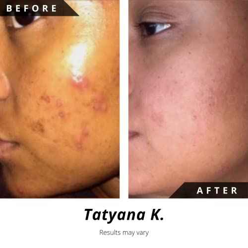 Noir D'or Acne Scar Treatment, Hyperpigmentation Treatment for Face, Normal to Oily Acne Skincare | Three Step Scar Repair Set for Acne Scars and Dark Spot Remover | Breakout Acne Treatment for Scars