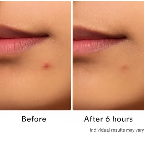 Hydrocolloid Acne Patches, 72 Count – Invisible Pimple Stickers