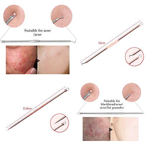 Blackhead Remover Pimple Extractor Kit for Acne & Blemish Treatment - Skin Care Tool with Case (Rose)