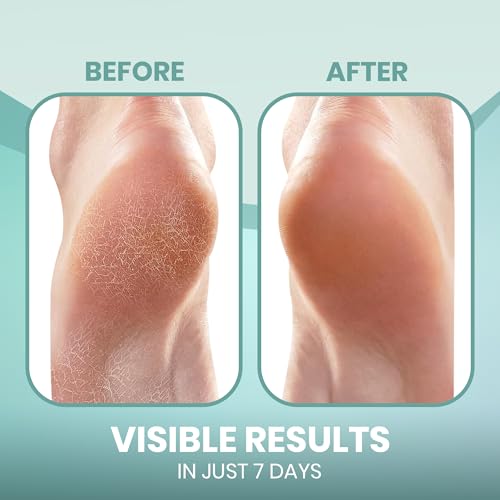 Moisturizing Gel Socks for Cracked Heels - 4-Pack Foot Care