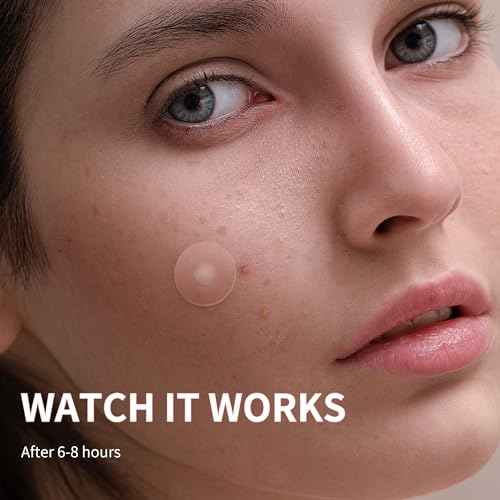 Pimple Patches for Face - 3 Size 510 Counts Hydrocolloid Acne Patches for Covering Zits and Blemishes, Spot Stickers with Salicylic Acid, Tea Tree Oil & Calendula Oil(8mm,10mm,12mm)