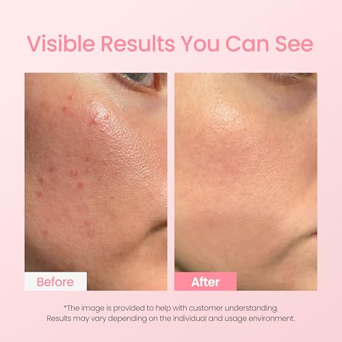 NEOGEN A-Clear Pink Calamine Spot Treatment - Blemish Eraser Powder