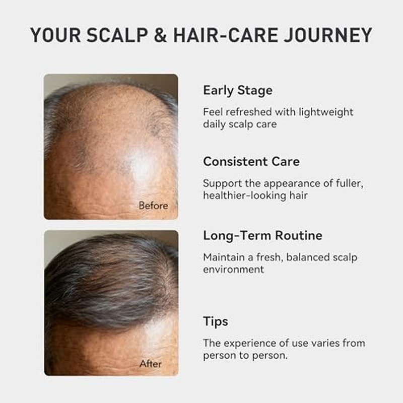KINTOR Hair Growth Spray for Men - DHT Blocker & Oil Control, 60ml
