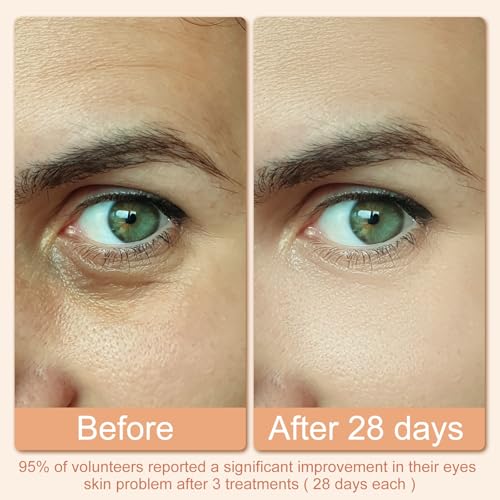 Hoakya Red Light Therapy Eye Massager for Dark Circles & Puffiness