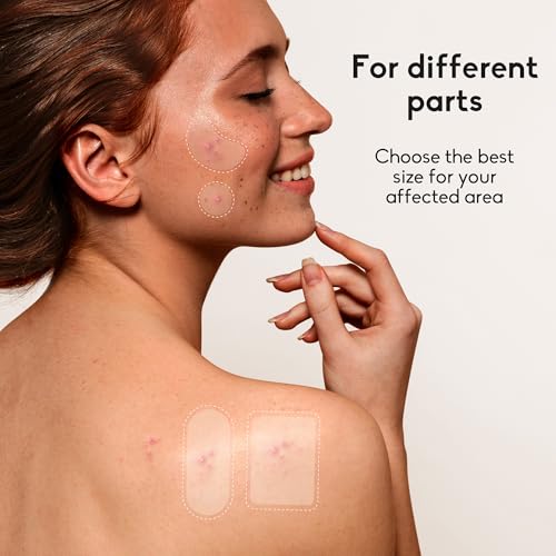 Daolyo 142 Large Acne Pimple Patches - 6 Sizes, 1 Pack of 142