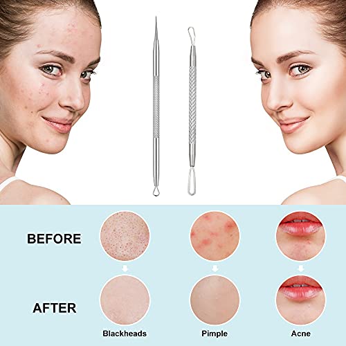 Blackhead Remover Tool 2-in-1 Pimple Extractor - Stainless Steel