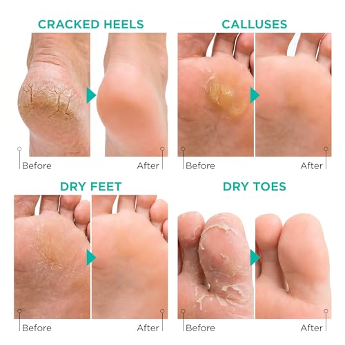 Lavinso Foot Peel Mask 2-Pack – Exfoliating Callus & Dead Skin Remover