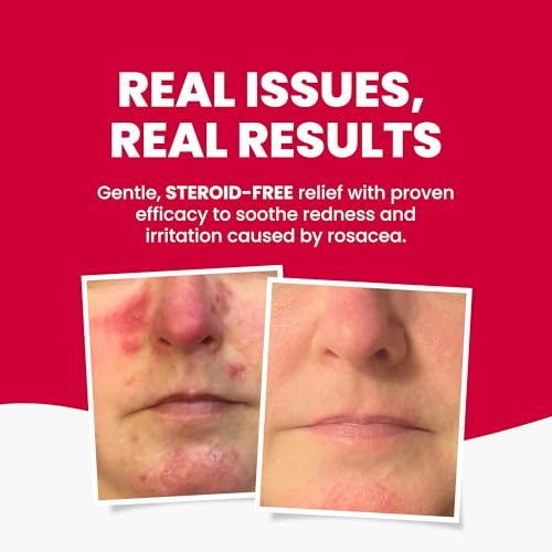 Grahams Natural Rosacea Treatment for Face Redness Moisturizer - Clinically Proven Anti Redness Face Cream to Soothe & Reduce Flare Ups - Natural, Hypoallergenic, Steroid-Free (2.64 fl oz)