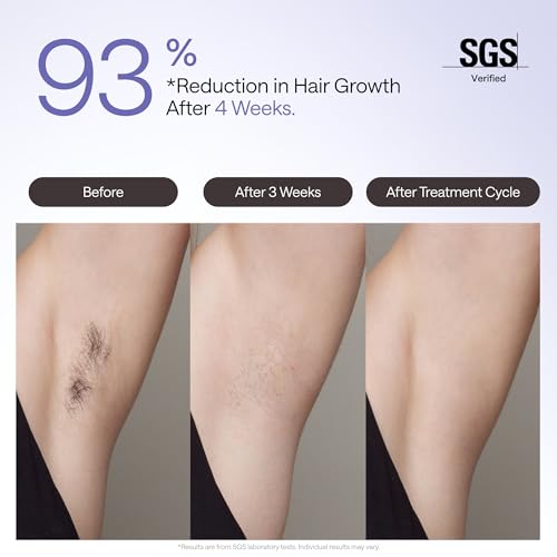 Ulike Laser Hair Removal Device Air 4 - IPL for Women & Men, Permanent Hair Reduction