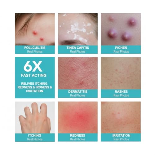 Folliculitis Cream – Cooling Menthol Relief for Itchy Bumpy Skin