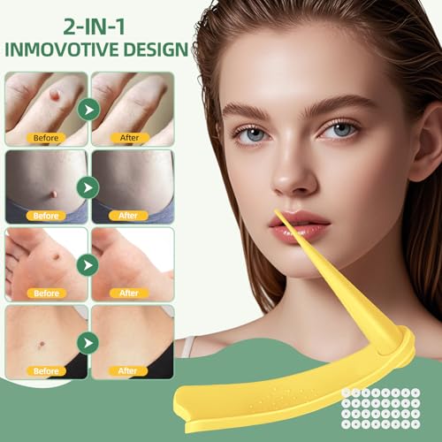 Dual-Size Skin Tag Removal Kit – At-Home Ligation System