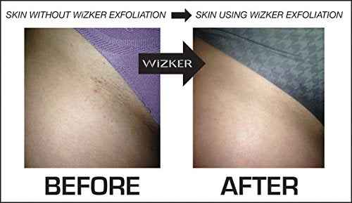 WIZKER Premium Ingrown Hair Exfoliating Brush for Sensitive Skin, Couple’s Edition Removes Razor Bumps, Reduces Shaving Irritation, Waxing, Laser – Waterproof, No Mold