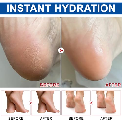 60% Urea Cream Stick with 2% Salicylic Acid – Cracked Heel Balm