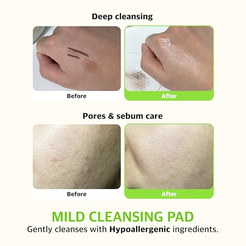 KLAVUU PHYTONCIDE QUICK CLEANSING PAD ? Gentle Makeup Remover, Deep Pore Care, Soothing & Moisturizing Formula, Hypoallergenic, Ideal for Sensitive Skin - 100 Count