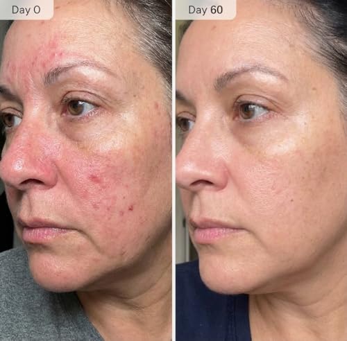 Micro Infusion Kit for Face & Neck | 0.25mm Stamp + Serums