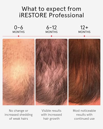 iRestore Pro Laser Hair Growth System - 282 Lasers