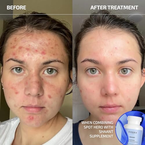 Codex Labs Shaant Spot Hero ? Clinically Tested 5% Sulfur Acne Spot Treatment | Shrinks Breakouts Without Over-Drying | For Sensitive, Blemish-Prone Skin | 0.5 oz