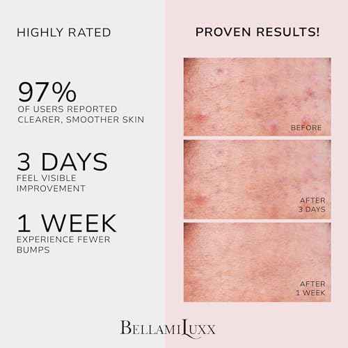 Butt Acne Clearing Treatment Cream: Body Acne Treatment for Folliculitis and Pimples on Buttocks, Thighs, and Body with 2% Salicylic Acid & Tea Tree Oil - Butt Cream for Smooth Skin