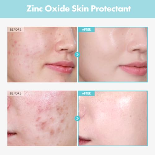 TOSOWOONG Zinc Oxide Cream 10% - Acne & Redness Relief, 50g