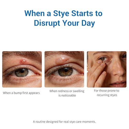 Stye Treatment Set : Eye Relief Serum with Rollerball, Tea Tree Wipes & Steam Masks for Styes, Blepharitis, Chalazion ? Soothes Redness, Irritation & Daily Care for Sensitive Eyes