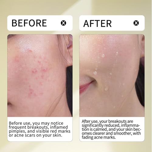 Multi-Acid 20% Serum,10% Azelaic Acid + 3% Tranexamic Acid,5% Zinc PCA + 2% Salicylic Acid,20% Active Formula for Blemish Care, Post-Acne Marks & Texture Refining,Suitable for Uneven & Acne-Prone Skin