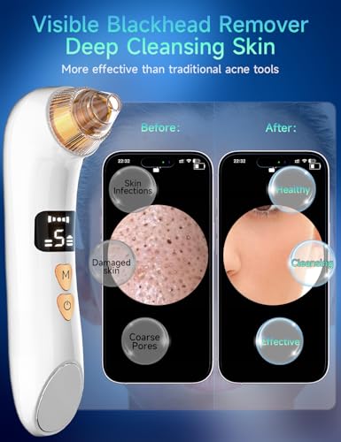 Blackhead Remover Pore Vacuum with HD Camera, 5 Suction Levels, 6 Probes