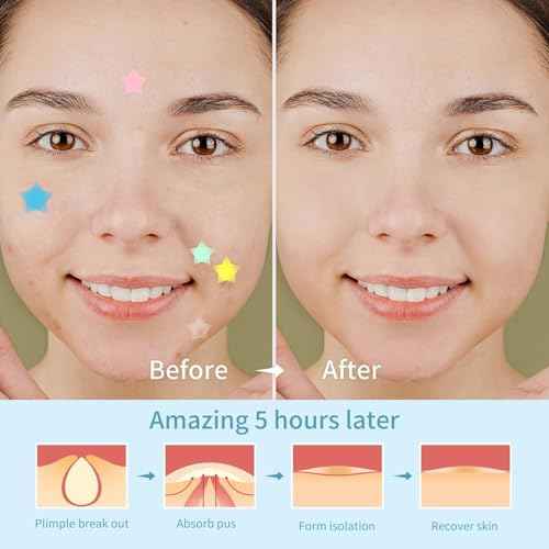 200 Count Star Pimple Patches for Face, Hydrocolloid Acne Pimple Patches with Tea Tree Oil for Party Gift Covering Zits Blemishes