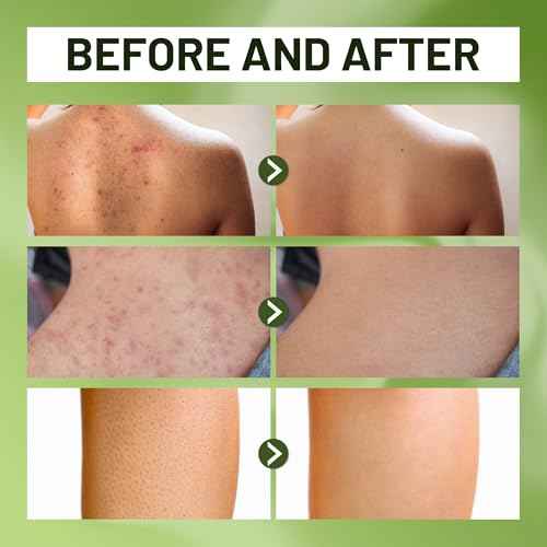 ABERA High-Performance Folliculitis Body Wash with Wild Bitter Melon Extract, BHA Shower Gel, Reduces Back Acne & Keratosis Pilaris, Folliculitis Treatment, Acne Body Wash for Sensitive Skin, 10.14 oz