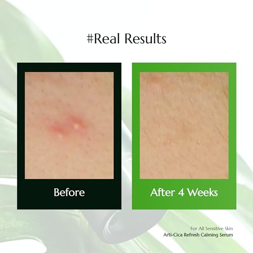 molvany Arti-cica Refresh Calming Serum - ASAP Soothe&Calm Skin, Improve Skin Balance Recommended for Sensitive Skin, 1.01 fl. oz.