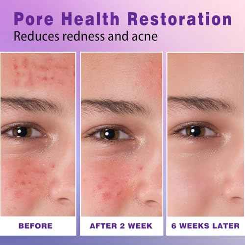 14% Azelaic Acid Acne Cream, Premium Azelaic Acid Facial Cream - Redness Relief For Face, Redness Reducing Skin Care, Prevents Acne Breakouts, Ease Pimple Clarify Skin Soothe Irritation,1 Oz