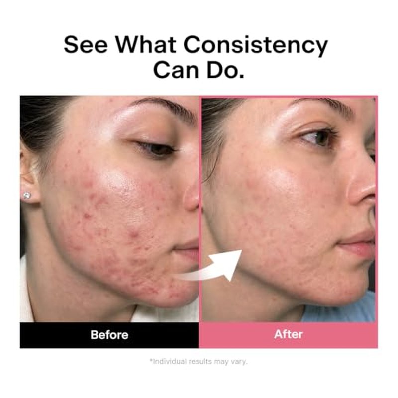 THOME Twenty Up Skincare Tool for Clear, Calm Skin