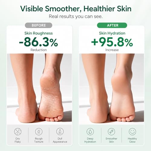 Urea Cream 40% for Feet - Cracked Heels & Callus Care 6oz