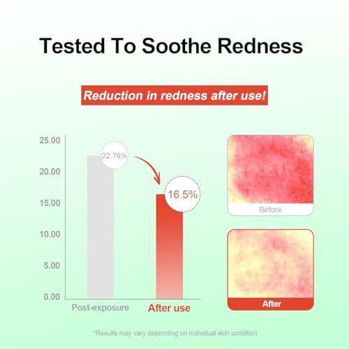 Azelaic Acid 10% Face Serum,Facial Serum for Sensitive Skin, Hyaluronic Acid, Niacinamide (30ml/1.01 fl oz.)